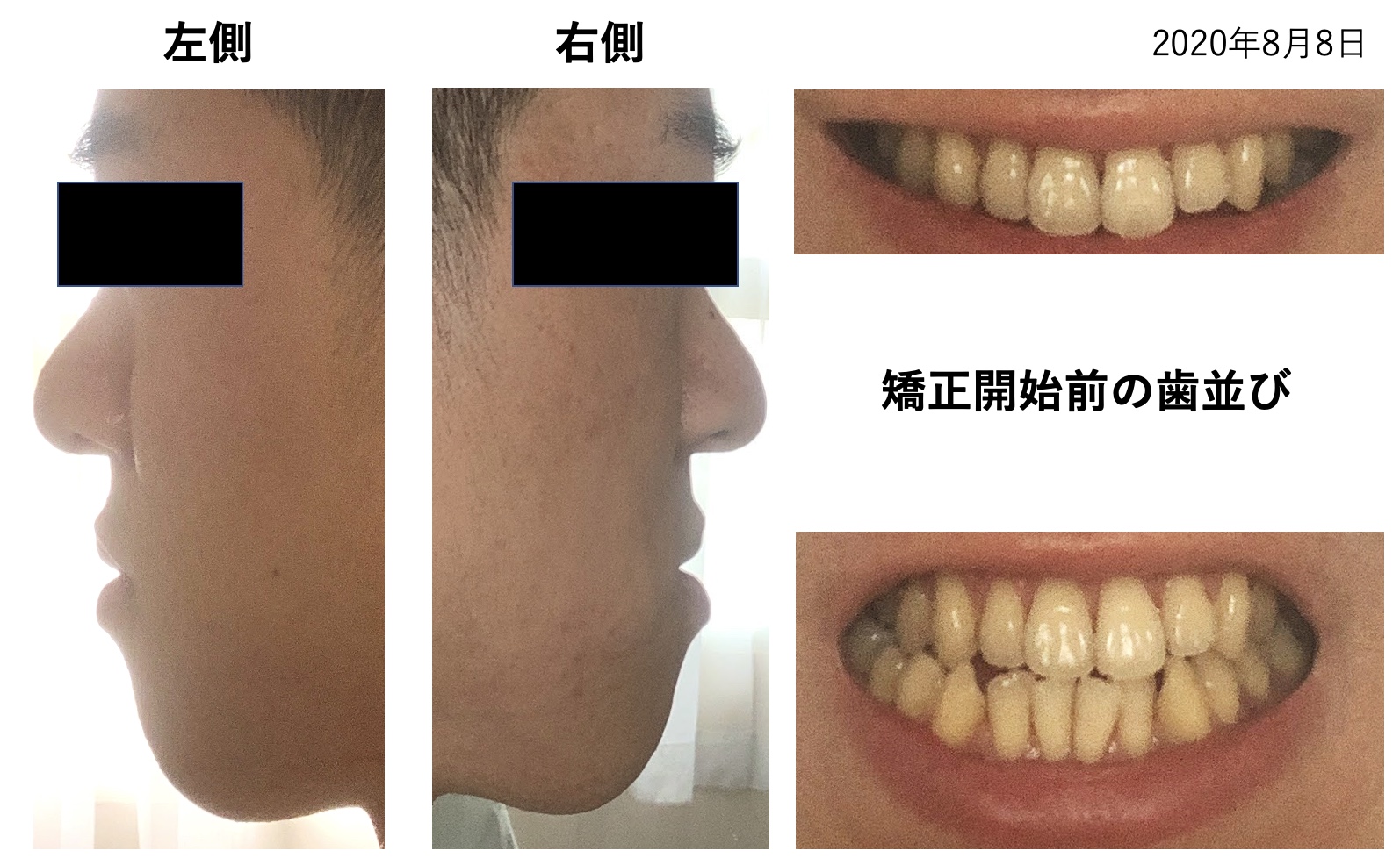 歯列矯正を１年間やった経過と歯並びの変化 大人の受け口は外科手術なしで治せるのか Tatsu04a