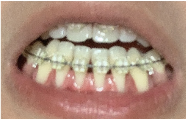 予防のためのヒント