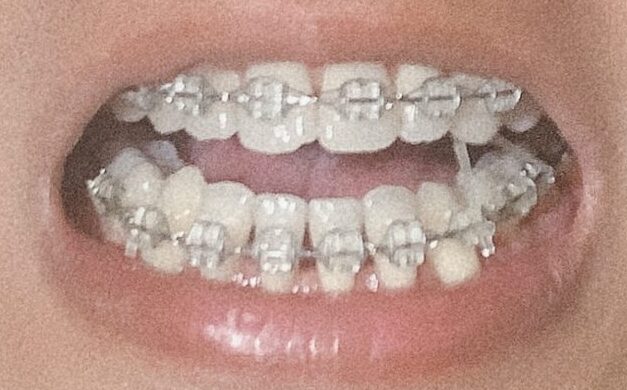 歯肉退縮の治療